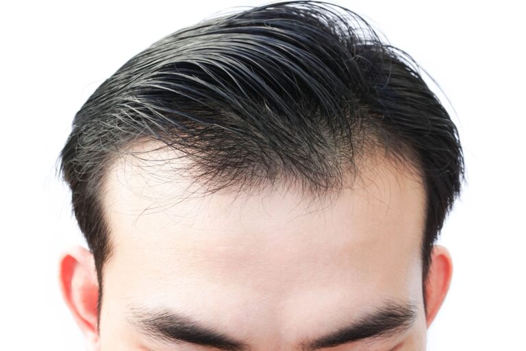 Garis rambut mundur