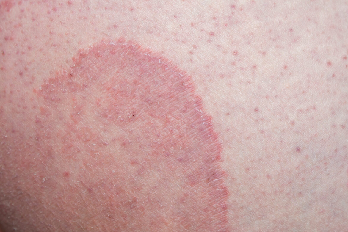 tinea cruris adalah