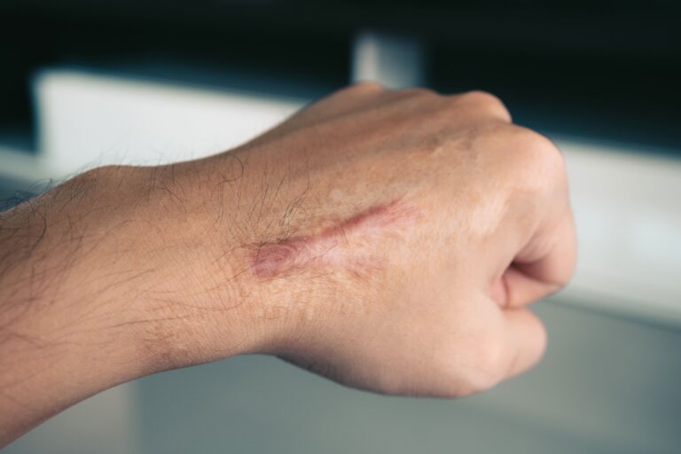 cara menghilangkan keloid
