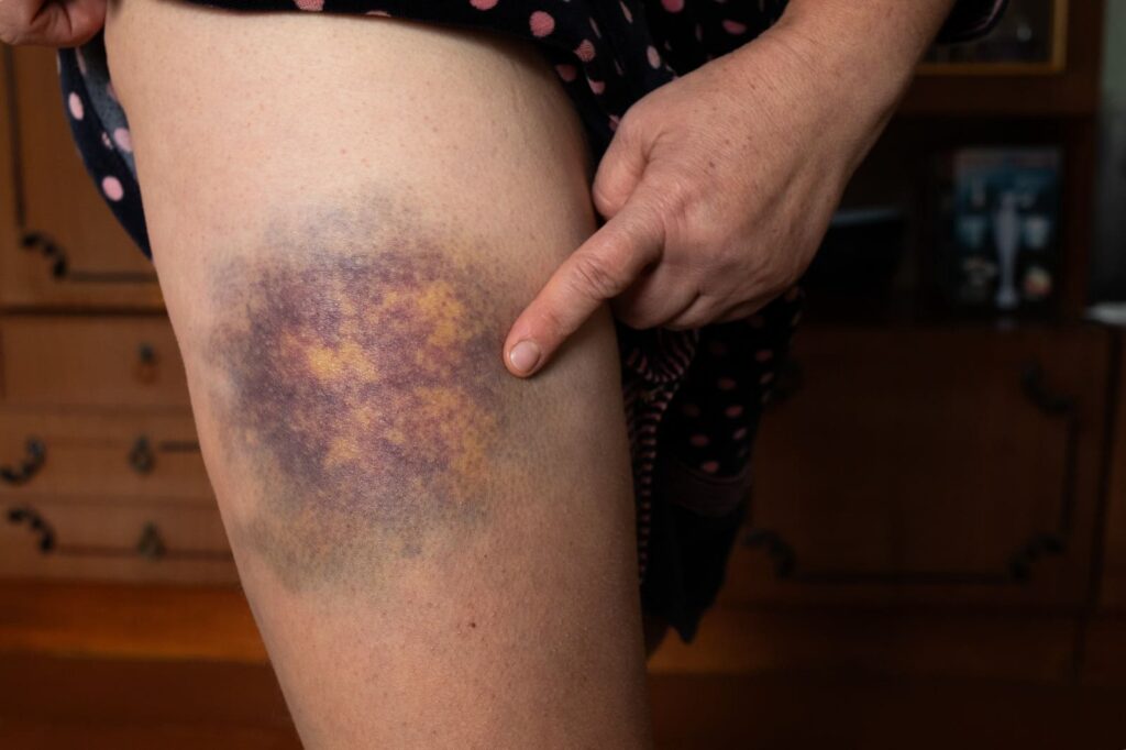 Hematoma adalah